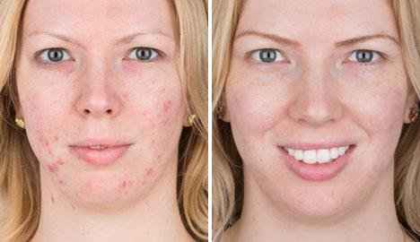 Moisturizer for Acne, Cicamed Medical Science, ASD Active Acne Scars Blemishes Oily Skin and Discoloration