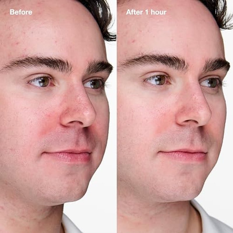 Clinique Acne Solutions Clinical Clearing Gel Acne Treatment With Witch Hazel + Salicylic Acid For Very Dry to Oily Skin Types | Oil-Free | Soothing