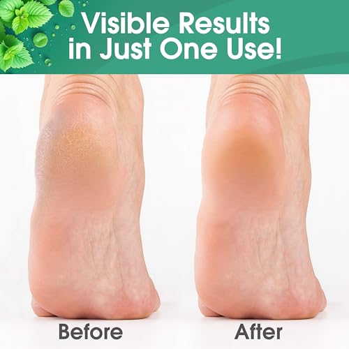 Callus Remover for Feet, Extra Strength Foot Callus Remover Gel, 16oz Salon Grade Home Pedicure Supplies for Dry Skin, Cracked Heel, Professional Strength Foot Care, Cool Mint