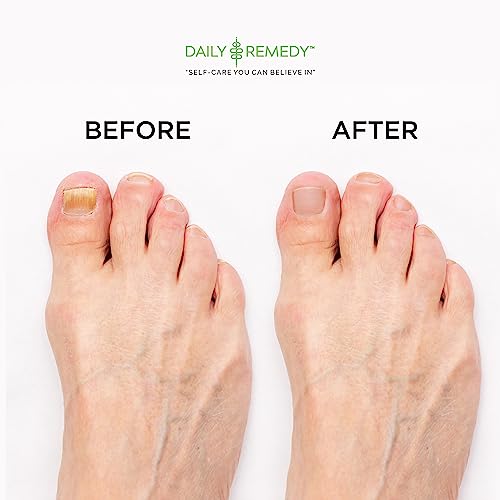 DAILY REMEDY EXTRA STRENGTH Tea Tree Oil Foot Soak w/ Epsom Salt Made in USA Toenails£¬Athlete's Foot£¬Itchy Feet£¬Stubborn Smelly Foot Odor£¬Pedicure Calluses & Soothes Sore Tired Achy Feet 16 oz£¬Black