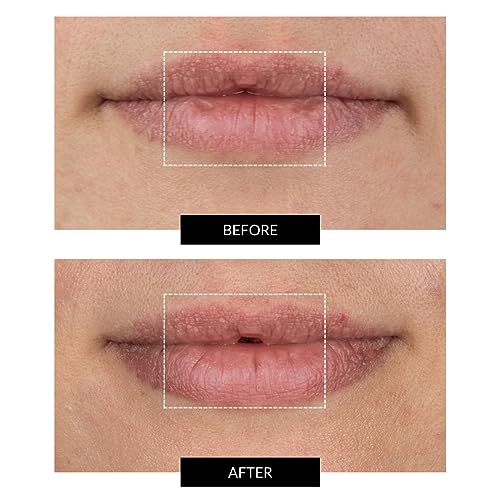 CurrentBody Skin LED Lip Perfector | Fully Wearable Anti-Aging Device for Lips | Soften Feather and Smile Lines for Plumper and Fuller Lips