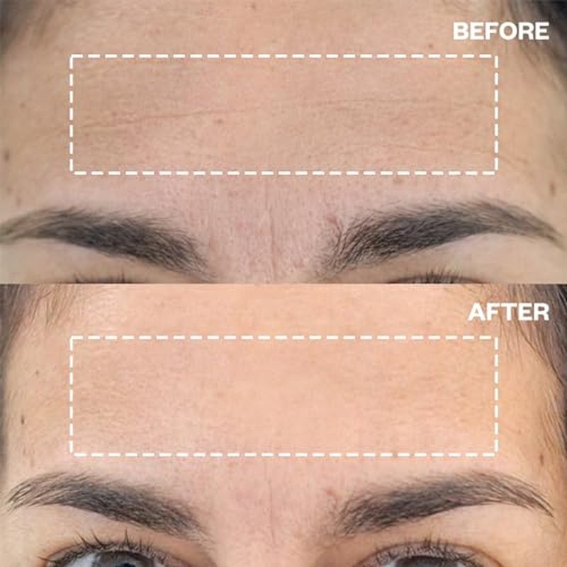 Wrinkles Schminkles Forehead Wrinkle Patches - Reusable Silicone Smoothing Pads for Brow Lift, Wrinkle Smoothers, Reduce Frown Lines & Face Lift (2 Pack)