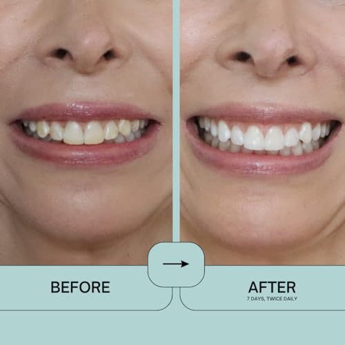Prostrips - 12 Shades Whiter Teeth - 28 Enamel Safe REMINERALIZING Gentle Strips ? 97% no Sensitivity