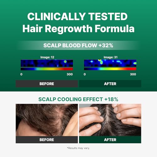 Spicule Microneedling Exosome Hair Growth Serum, Hair Loss Treatments for Women and Men, Peppermint Oil Cooling Scalp Serum, Menthol, Korean Hair Care (0.5 fl oz / 15ml)