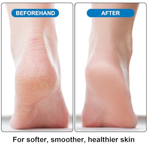 Foot Pumice Stone 4 Pack Pedicure Stone for Feet Pumice Sponge for Feet Callus Remover and Scrubber Double Sided Pedicure Foot Pumice Stone for Feet and Heels Callus and Dead Skins (Purple)