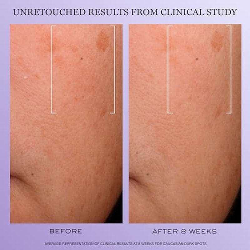 Lanc?me R?nergie H.C.F. Triple Serum - Hyaluronic Acid Serum for Visible Correction of Anti Aging Signs & Dark Spots - With Vitamin C+, Niacinamide & Ferulic Acid