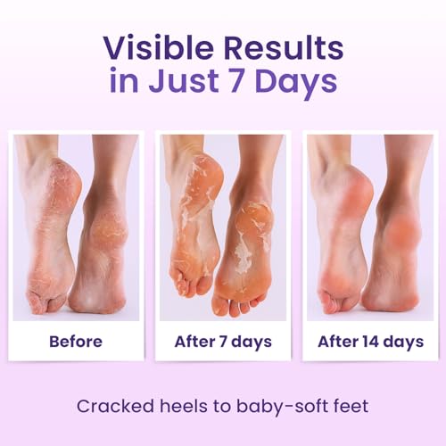 Foot Peeling Mask (6 pairs) Exfoliating Foot Mask for Dry Cracked Feet with Lavender & Shea Butter, Dead Skin & Callus Remover for Feet, Exfoliating Socks for Women & Men, One Size Fits Most
