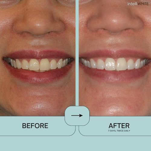 Prostrips - 12 Shades Whiter Teeth - 28 Enamel Safe REMINERALIZING Gentle Strips ? 97% no Sensitivity