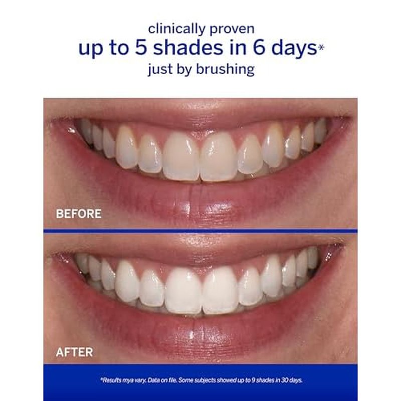 Supersmile The Works ? Professional Whitening Toothpaste and Accelerator Duo ? Whitens Up to 6 Shades