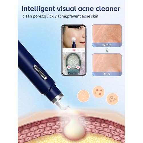 Visual Blackhead Remover Tools with Camera,Pimple Popper Extractor Tool Kit with Camera 20X 1080P Pore Cleaner Acne Comedone Whitehead Extractor Kit for iPhone/Android (Blue)