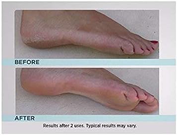 Emjoi Micro-Pedi Callus Remover - Effective Foot Care Tool w/Bonus Rollers | Turquoise