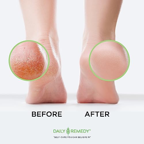 DAILY REMEDY EXTRA STRENGTH Tea Tree Oil Foot Soak w/ Epsom Salt Made in USA Toenails£¬Athlete's Foot£¬Itchy Feet£¬Stubborn Smelly Foot Odor£¬Pedicure Calluses & Soothes Sore Tired Achy Feet 16 oz£¬Black