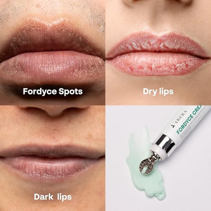 Abera Fordyce Cream ? Advanced Formula with HPR (Next-Gen Retinoids), Fordyce Spot Remover For Lips, All-day Moisturizing, Help Improve Dry, Chapped and Dark Lips, For Sensitive Lips (1.4 Oz) (Set 2)