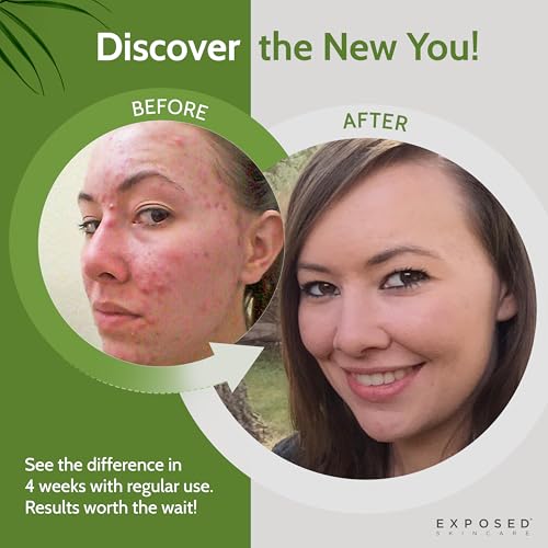 Exposed Skin Care, Acne Treatment Kit with 2.5% Salicylic Acid and 3.5% Benzoyl Peroxide to Clear Up Teen, Adult, Hormonal and Cystic Acne ? Natural, Non-toxic and Cruelty Free