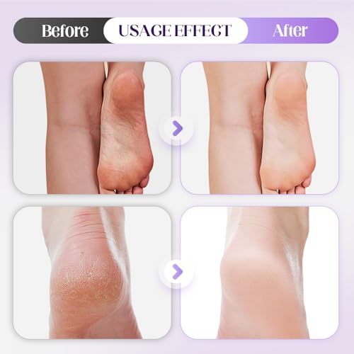 Foot Pumice Stone with Stripes to Increase Friction, 2025 Upgraded Professional Pedicure Foot Pumice Stone for Feet Hard Skin Callus Remover and Scrubber, Durable Exfoliating Stone for Spa Pedicure