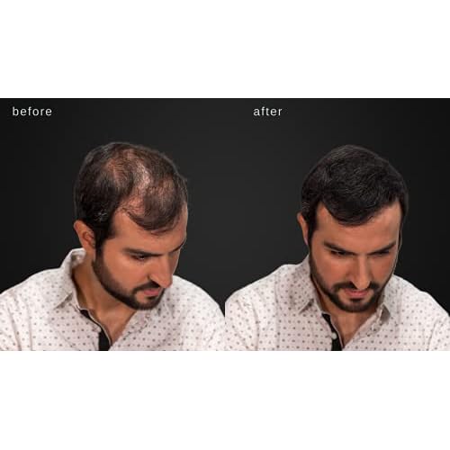 LUXE Hair Building Fibers - Thickening Fibers - CONFIDENCE IN A JAR ? 2 Months+ Supply! ? Hypoallergenic, Dermatologist Tested ? Multiple Colors Available (Dark Brown)