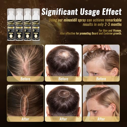 5% Minoxidil Spray for Men & Women (4 Month Supply)-Extra Strength Hair Growth Spray with Biotin & Castor Oil,Clinically Proven for Thinning Hair & Beard Regrowth, Non-Greasy Formula 4 pack£¨8.12 oz)