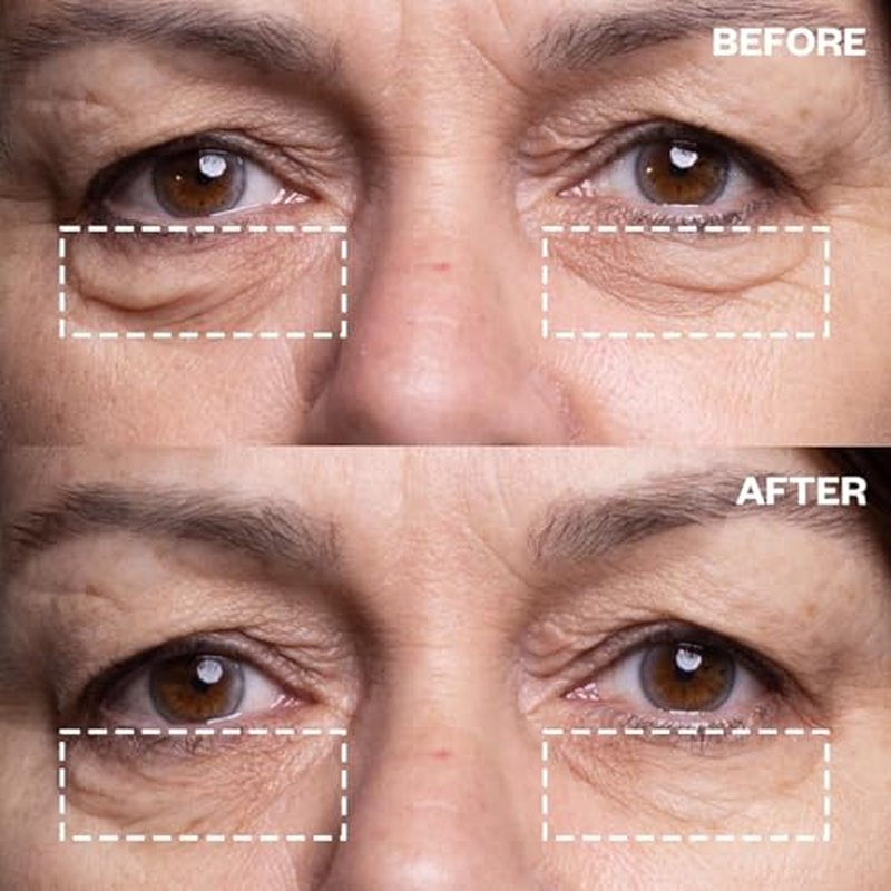 Wrinkles Schminkles Under Eye Patches - Rejuvenate Wrinkles with Medical Grade Silicone Reusable Anti-Wrinkle Patches for Under Eye Treatment, Banish Dark Circles (3 Pairs)