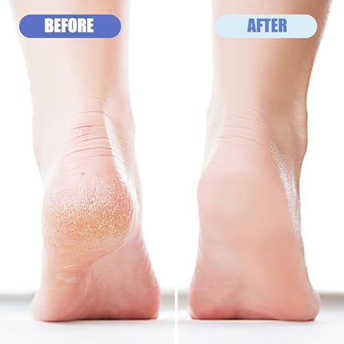 4 Pack Foot Pumice for Feet Pedicure Plastic Foot Scrubber Exfoliator for Dead Skin Cracked Heel Repair Callus Remover