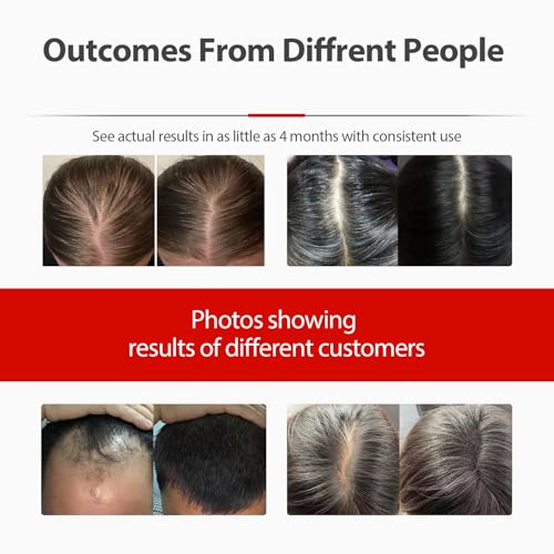 2026 Upgrade Laser Cap, Red Light Therapy for Hair Growth