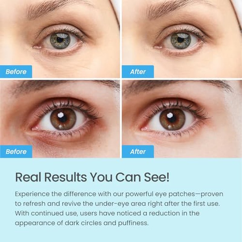 PLANTIFIQUE Superfood Under Eye Patches ? 12 Pairs with Hyaluronic Acid for Dark Circles & Puffy Eyes ? Anti-Aging Skincare Gel Mask, Gift for Women & Men