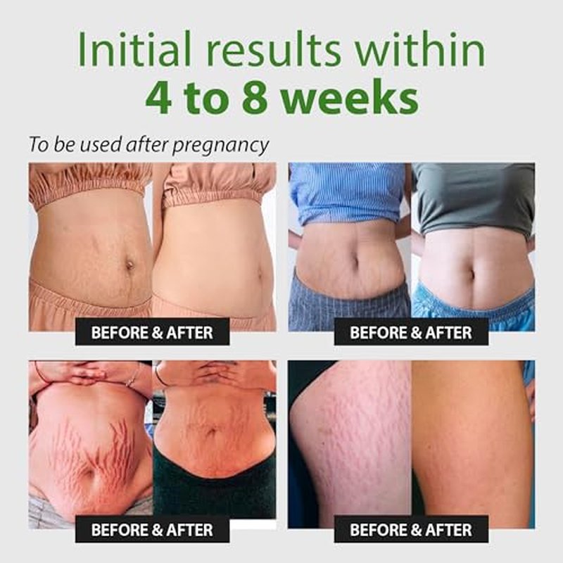 Abera Ovela Maternity Stretch Mark Cream for Pregnancy and Weight Fluctuations, Stretch Mark Treatment Pregnancy Must Haves, Deep Stretch Mark Removal, All Skin Types, 1.69 fl oz, Set of 3