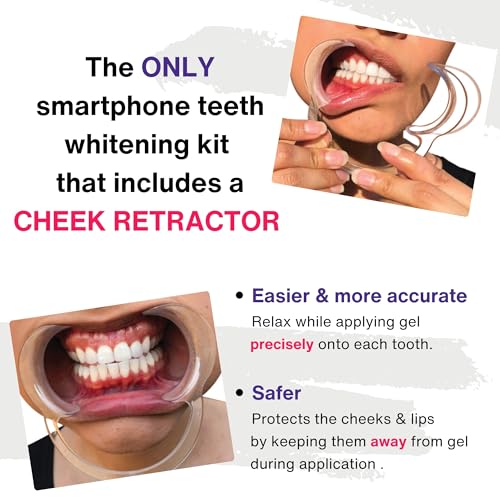 Professional Teeth Whitening Kit, LED Accelerator Light, 36% Carbamide Peroxide Teeth Whitening Gel, 20 Whitening Treatments, Remineralizing Gel, USA-Made Gels