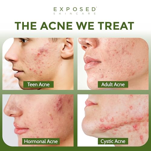 Exposed Skin Care, Acne Treatment Kit with 2.5% Salicylic Acid and 3.5% Benzoyl Peroxide to Clear Up Teen, Adult, Hormonal and Cystic Acne ? Natural, Non-toxic and Cruelty Free