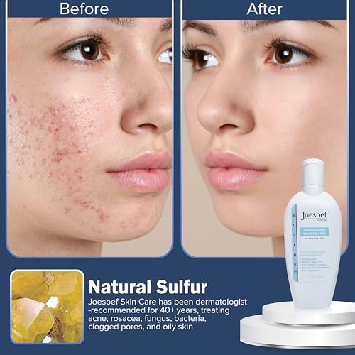 JOESOEF SKIN CARE Sulfur Soap for Acne Pharmaceutical Grade Dermatologists Approved for Acne Rosacea. Sulfur Acne Treatment for Skin Care Daily Routine. (2pack)