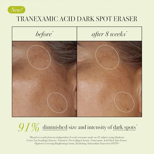 Replenix Tranexamic Acid Dark Spot Treatment, Daily Medical-Grade Topical Discoloration Serum for Uneven Skin Tone, Gluten, Paraben, Fragrance & Cruelty Free (0.5 oz)