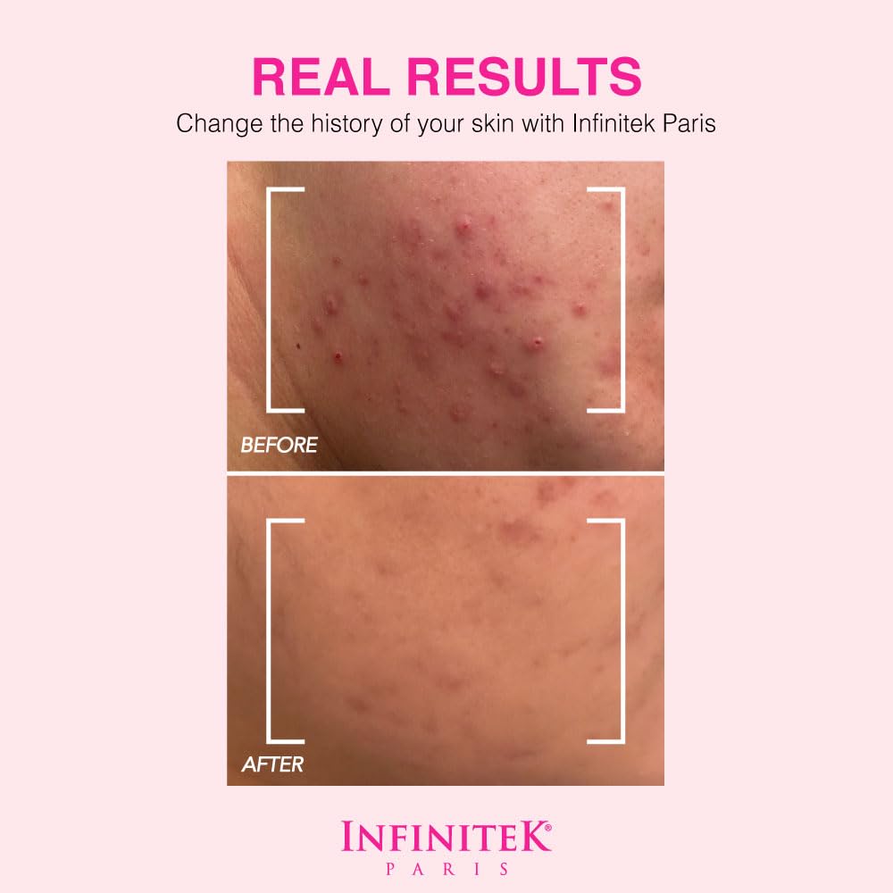 Infinitek Paris | Dead Sea Mud Mask | Galentine’s Gifts & Valentine’s Day Gifts for Women | Face Mask for Acne Treatment, Blackhead Remover, Antioxidant Pore Cleaner | 2.47 oz / 70 g