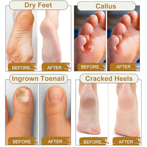 10Pack Foot Soak with Epsom Salt, Epsom Salts for Soaking,Dead Sea Salt Soothes Tired Feet, Odor Scent, Spa Pedicure Care Foot Soaking, with feet scrubber