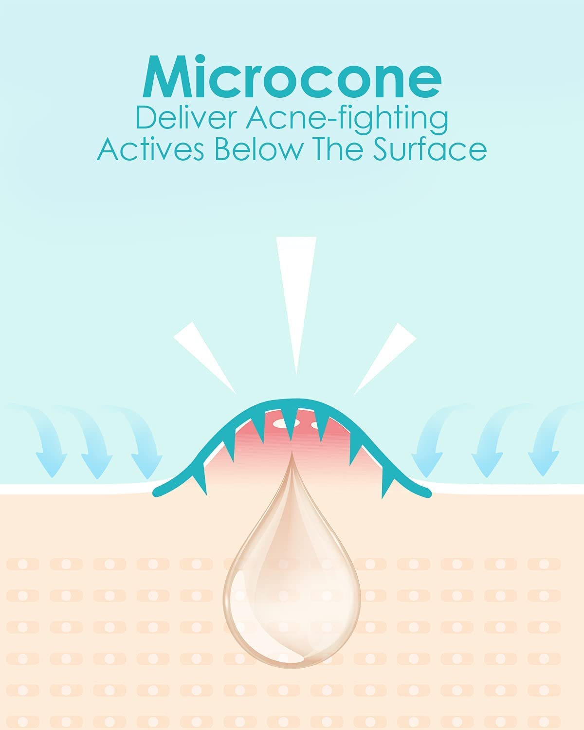 Microdart Acne Patch - Hyaluronate & Salicylic Acid Hydrocolloid Treatment for Deep Blemishes | 72 Patches