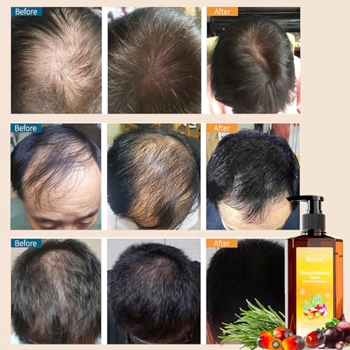 Batana Oil Shampoo for Hair Growth ? Infused with Rosemary & Onion, Anti Hair Loss & Thickening Treatment for Women & Men, Promotes Regrowth, Sulfate Free Natural Formula, 10.14 fl oz