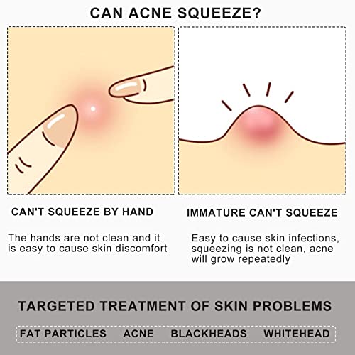 Pointed Blackhead Removal, 2-in-1 Acne Extractor Tool - Stainless Steel Whitehead Remover for Face/Nose