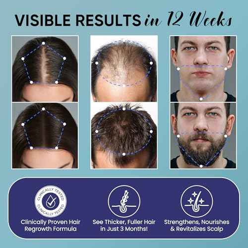 5% Minoxidil for Men and Women Hair Growth: Minoxidil Spray Hair Regrowth Treatment Serum with Biotin & Rosemary -Stop Hair Thinning and Hair Loss For Stronger Thicker Longer Hair