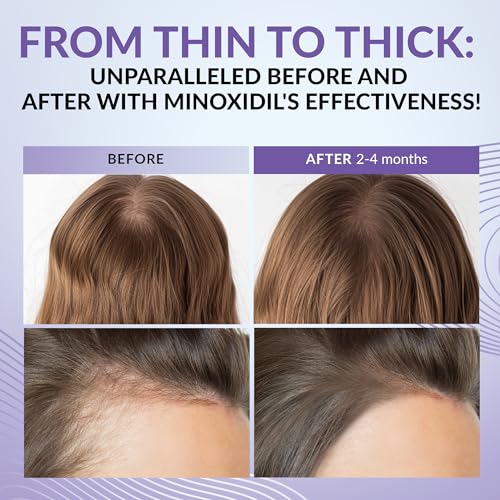 Minoxidil for Women 2% - Hair Growth Serum Women + Vitamin E, Ginseng, Ginger Extract, Biotin Hair Growth Serum - Hair Loss Regrowth & Thickening Treatment Helper