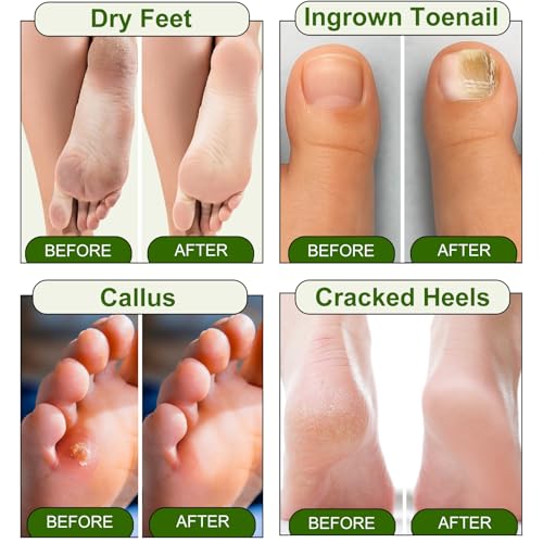 Epsom Salt Foot Soak, 10Pack Tea Tree Oil and Lavender Oil Epsom Salts for Soaking, Dead Sea Salt Spa Pedicure Care Softens Thick Calluses & Corns, Athletes Foot, with feet scrubber