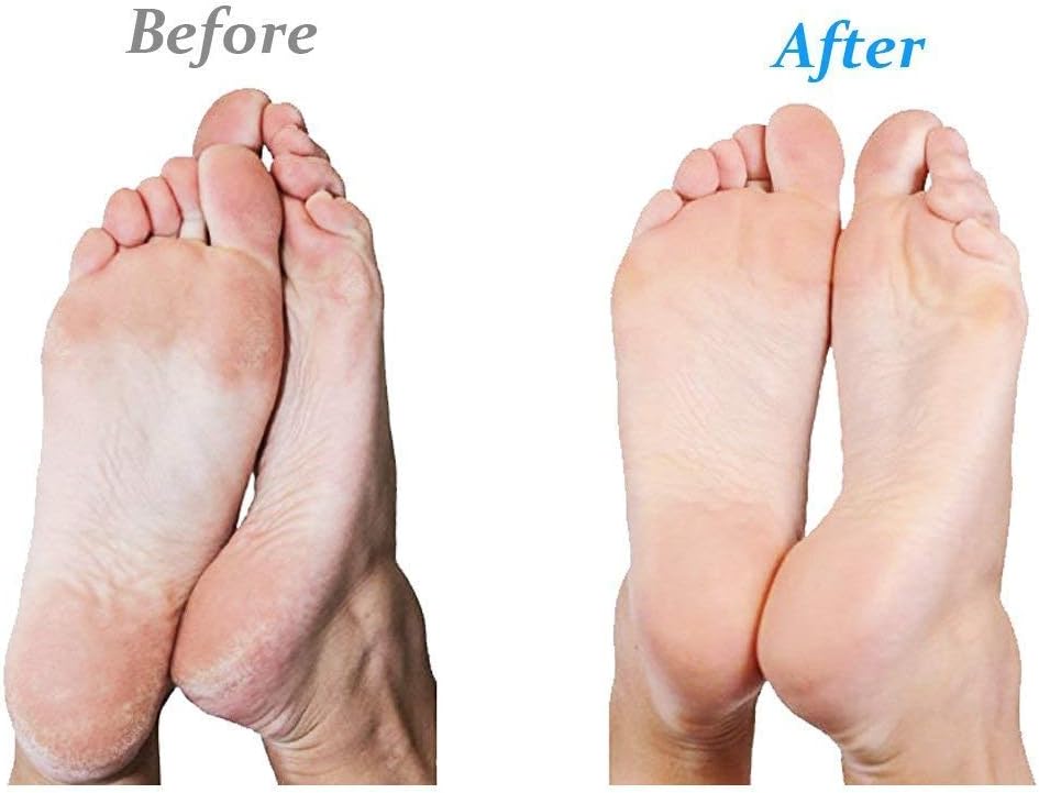 Emjoi Micro-Pedi Callus Remover - Effective Foot Care Tool w/Bonus Rollers | Turquoise
