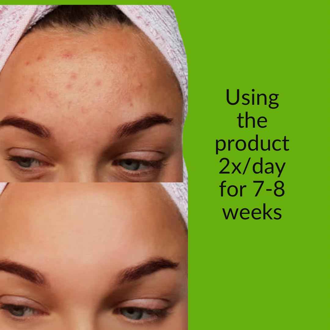 Xtracta Pore Control Serum for Acne-Prone Skin – Salicylic Acid, Azelaic Acid, Colloidal Sulfur & Ginkgo – Plant-Based Oil & Blackhead control, 30ml