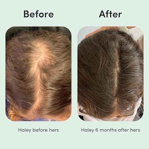 hers Hair Regrowth Treatment - Topical Minoxidil 2% Solution for Women - Supports Thicker, Fuller Hair - Non-Greasy - Unscented, 2 Pack