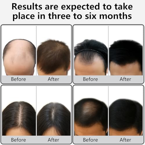 Laser Therapy Hair Growth Comb, Models: Lasercomb-001