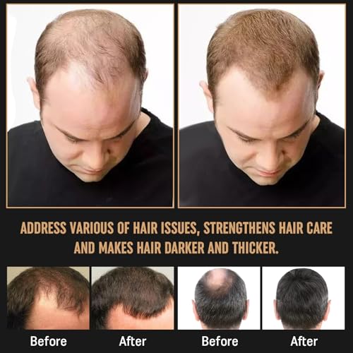 2Pcs Root Activator Shampoo - Hair Growth Root Activator Shampoo for Men and Women - Natural Formula for Hair Loss and Thinning Hair