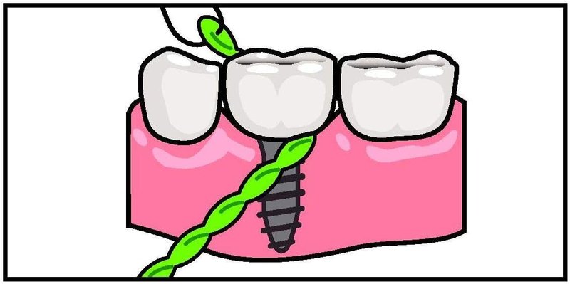 IDontix X-Floss Brace - Durable Green Support for Enhanced Performance