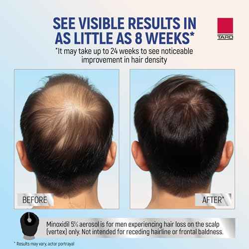 Taro Minoxidil for Men, 2.11 Oz (1 Month Supply) Clinically Proven to Regrow Hair, Topical Aerosol Foam 5%, Hair Thinning Treatment