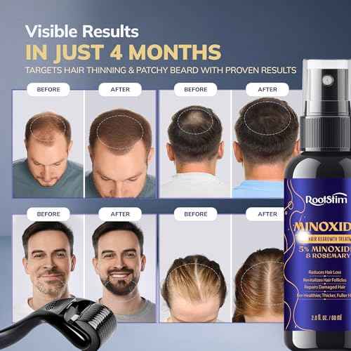 5% Minoxidil Kit for Men and Women with 0.25 mm Derma Roller ? Beard Growth Kit & Hair Regrowth Spray ? Targets Thinning Hairlines, Crowns & Patchy Beards ? 60 mL