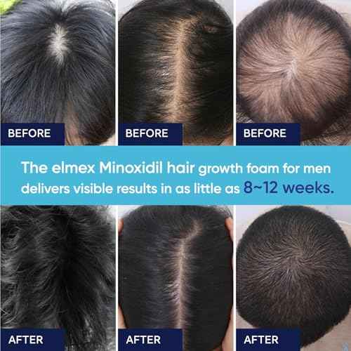 5% Minoxidil Foam for Men and Women, Minoxidil for Men Foam for Hair and Beard, Minoxidil for Women Hair Growth (6 Ounce)