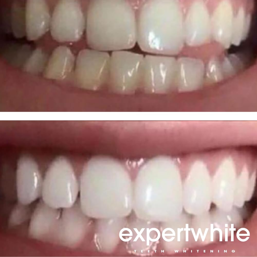 Expertwhite 44% Teeth Whitening Gel - Refills for Trays – Professional Strength Carbamide Petoxide Syringes, 4 × 3cc, 15-Minute Treatment, Gels Only (No Trays)