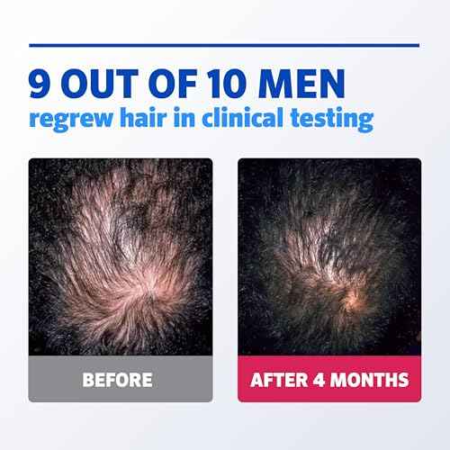 Rogaine Men¡¯s 5% Minoxidil Foam Hair Regrowth Treatment, FDA Approved Brand, Proven to Improve Hair Regrowth, Extra Strength Minoxidil Foam, Unscented Aerosol, 4 Month Supply (4 x 2.11 oz Cans)