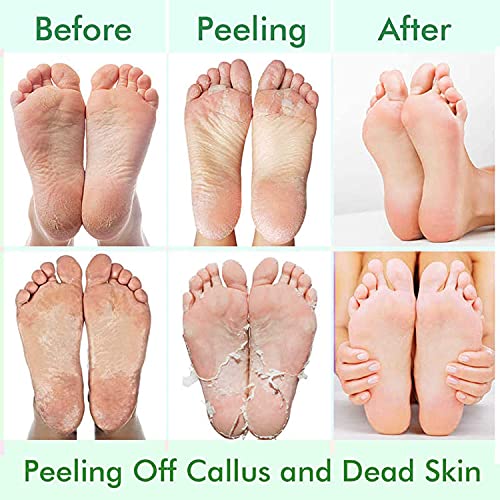 5 Pack Foot Peeling Mask,Exfoliator Peel Off Calluses Dead Skin Callus Remover,Foot Mask for Dry Cracked Feet,Foot Peel Masks for Men and Women Feet Peeling Mask for Stocking Stuffers